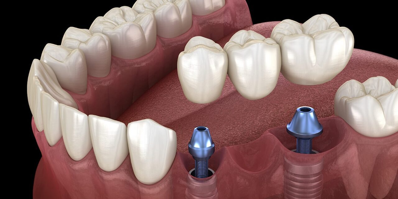 Dental Implant Cost In Delhi NCR & Teeth Replacement Cost In India