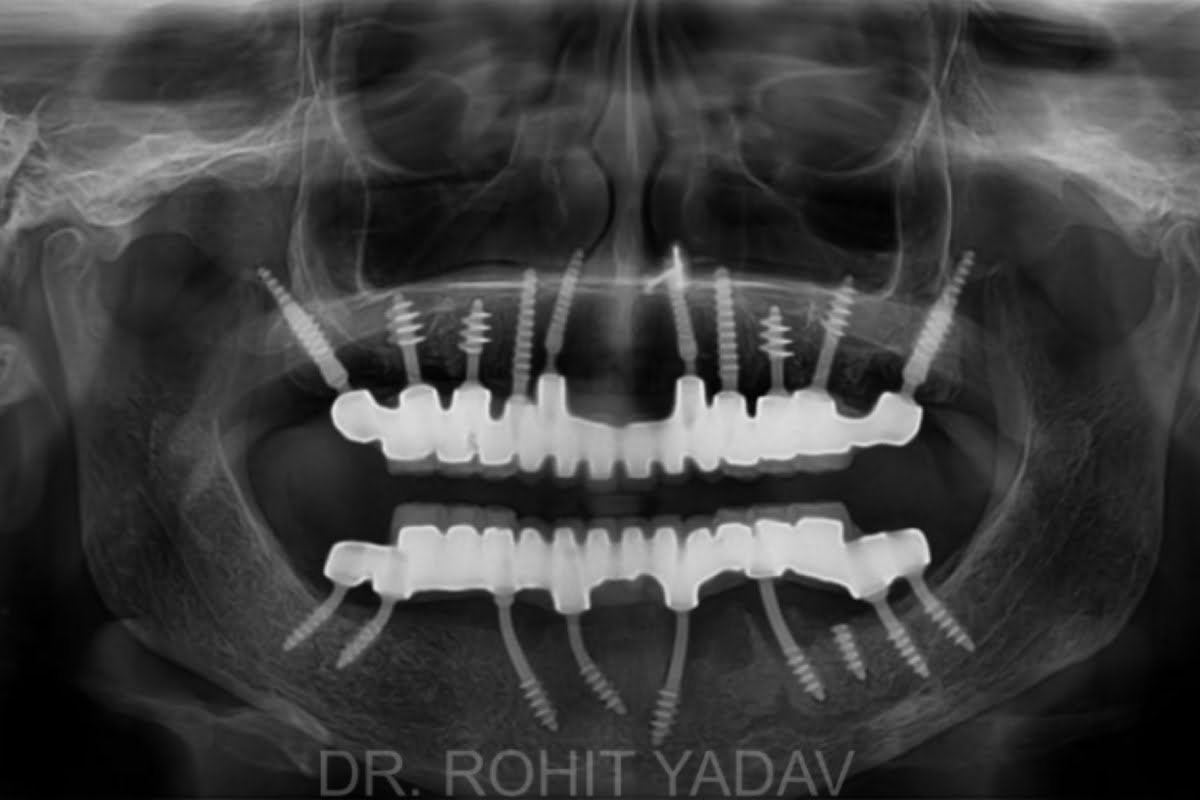 https://www.drrohityadav.com/wp-content/uploads/Dr-Rohit-Yadav-OPG-Strategic-Implant.jpg