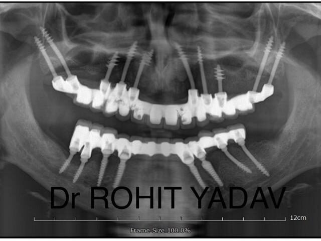 Dr. Rohit Yadav - Patient OPG - Best Implantologist in Noida (1)