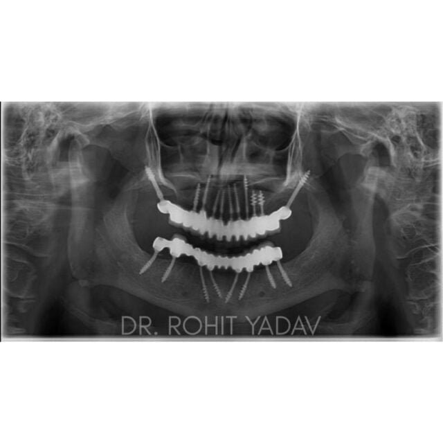 Dr. Rohit Yadav - Patient OPG - Best Implantologist in Noida (14)