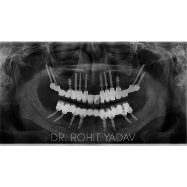 Dr. Rohit Yadav - Patient OPG - Best Implantologist in Noida (15)