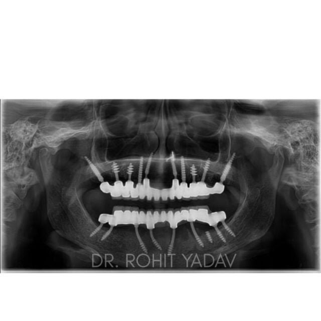 Dr. Rohit Yadav - Patient OPG - Best Implantologist in Noida (16)