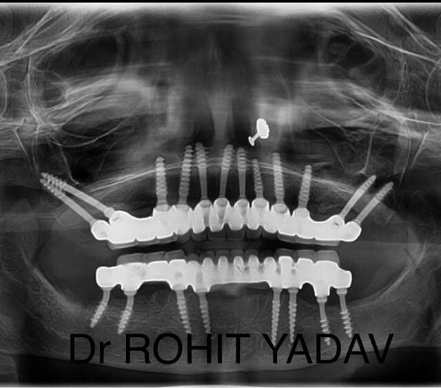 Dr. Rohit Yadav - Patient OPG - Best Implantologist in Noida (20)