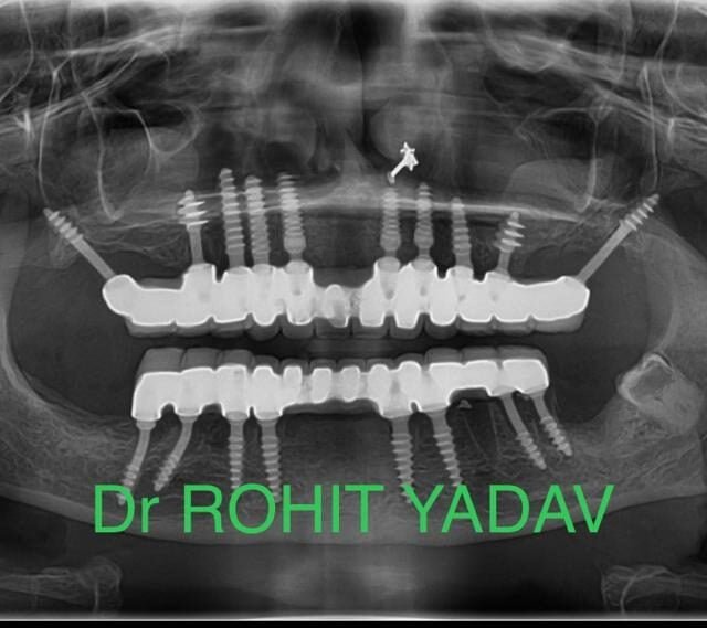 Dr. Rohit Yadav - Patient OPG - Best Implantologist in Noida (21)