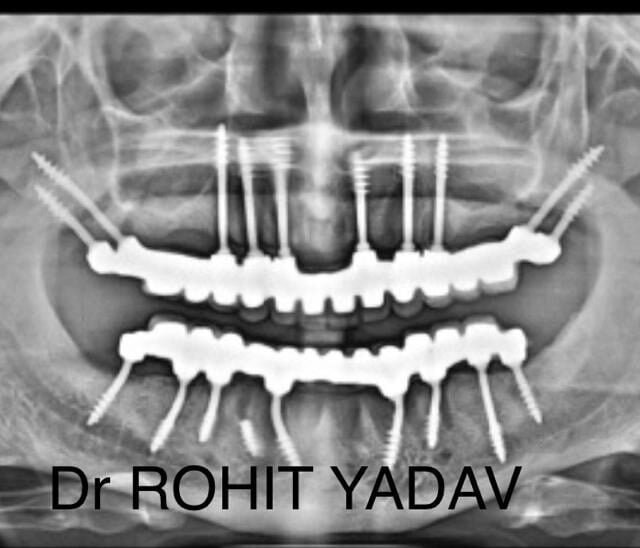 Dr. Rohit Yadav - Patient OPG - Best Implantologist in Noida (23)