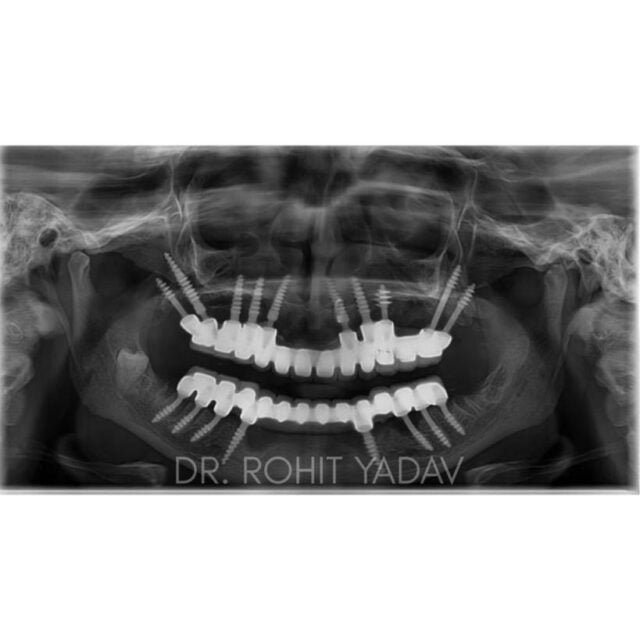 Full Mouth Dental Implant