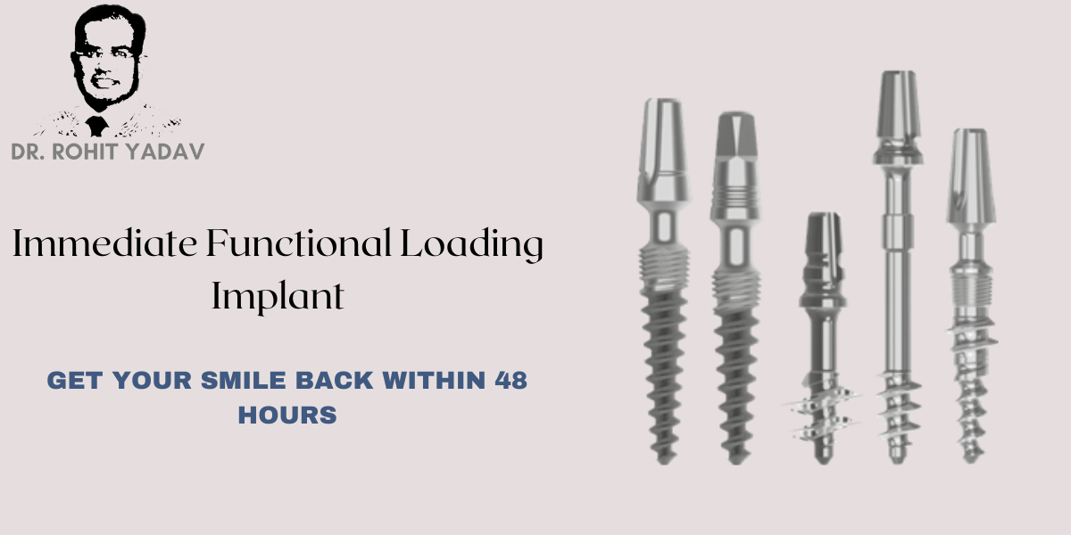 FAQs: Immediate Functional Loading Implants By Dr. Rohit Yadav